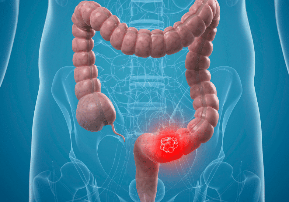 Colonal Rectal Cancer_ treatment in Ayurveda | Arogyavedh Ayurveda | Dr. Banashree Patil Baner Balewadi