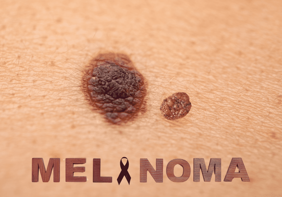 Melanoma Cancer_ treatment in Ayurveda | Arogyavedh Ayurveda | Dr. Banashree Patil Baner Balewadi