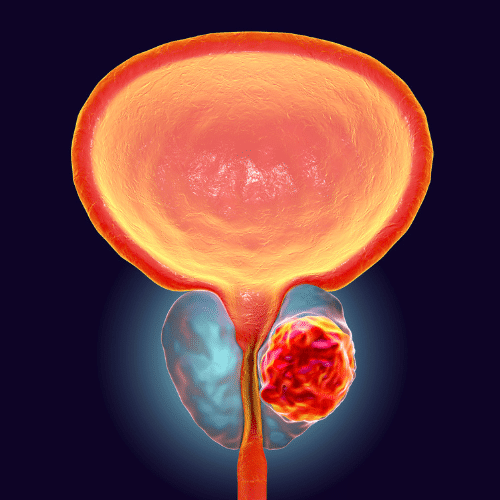 Prostate Cancer treatment in Ayurveda | Arogyavedh Ayurveda | Dr. Banashree Patil Baner Balewadi