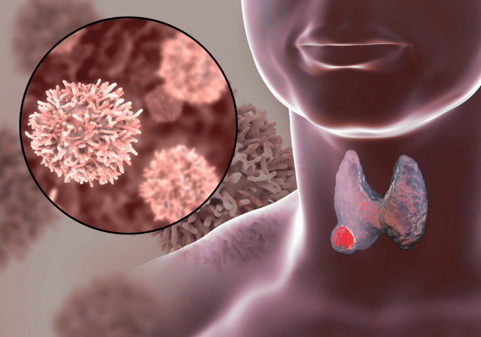 Thyroid Cancer_ treatment in Ayurveda | Arogyavedh Ayurveda | Dr. Banashree Patil Baner Balewadi
