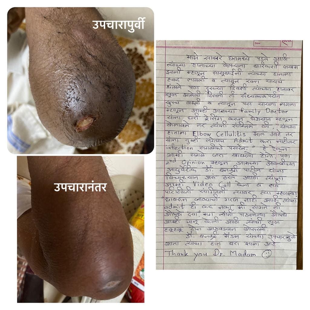 Infected wound (व्रण) treatment and patients review Arogyavedh Ayurveda baner balewadi