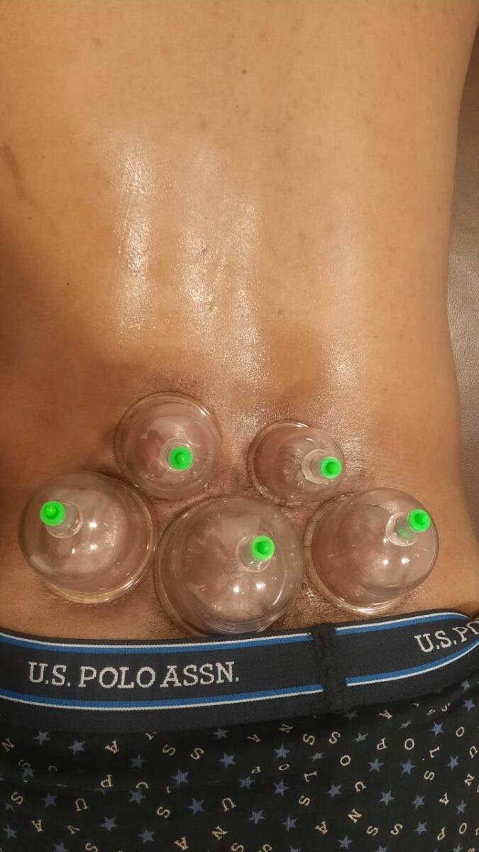 अलाबु(cupping therapy) in ayurveda balewadi